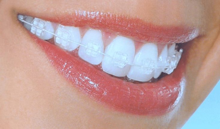 Discreetly Straighter Teeth: Why Clear Braces Are Trending