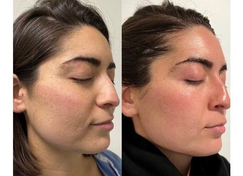 Before and after Salmon Sperm Facial at The Collagen Bar
