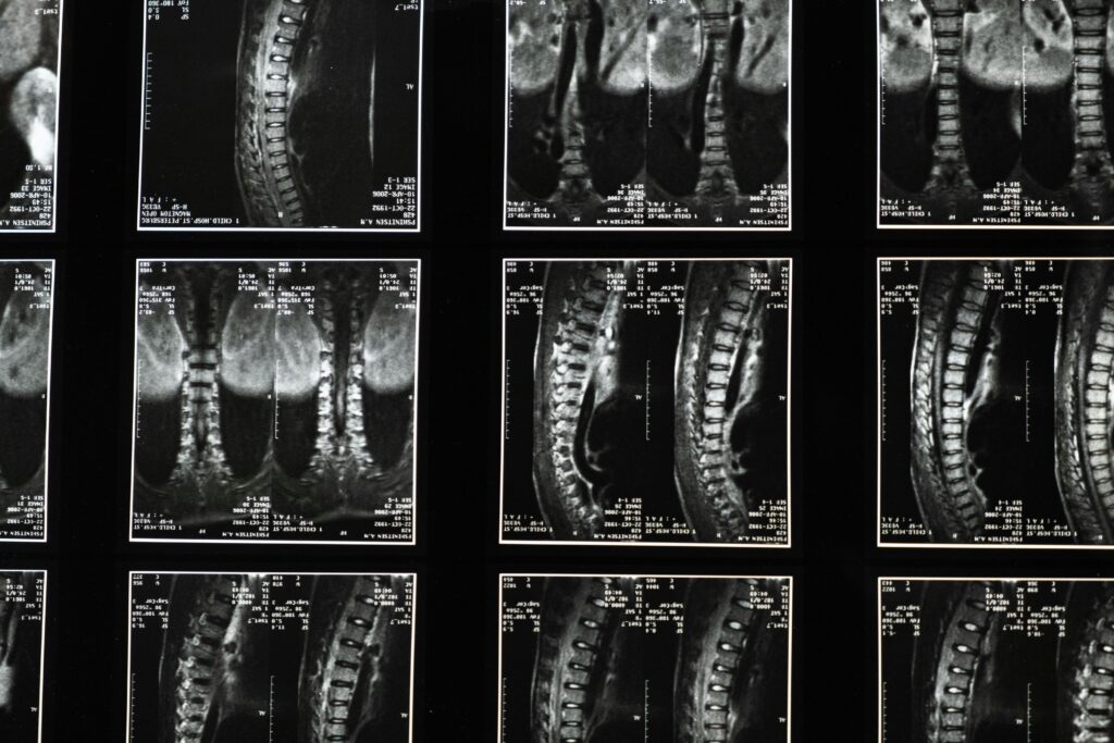 Back Injury or Spinal Cord Injury? Why the Diagnosis Matters for Your Case